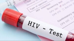 dunyada 408 milyon kisi hiv ile yasiyor turkiyede artis suruyor JFMPnqH8.jpg